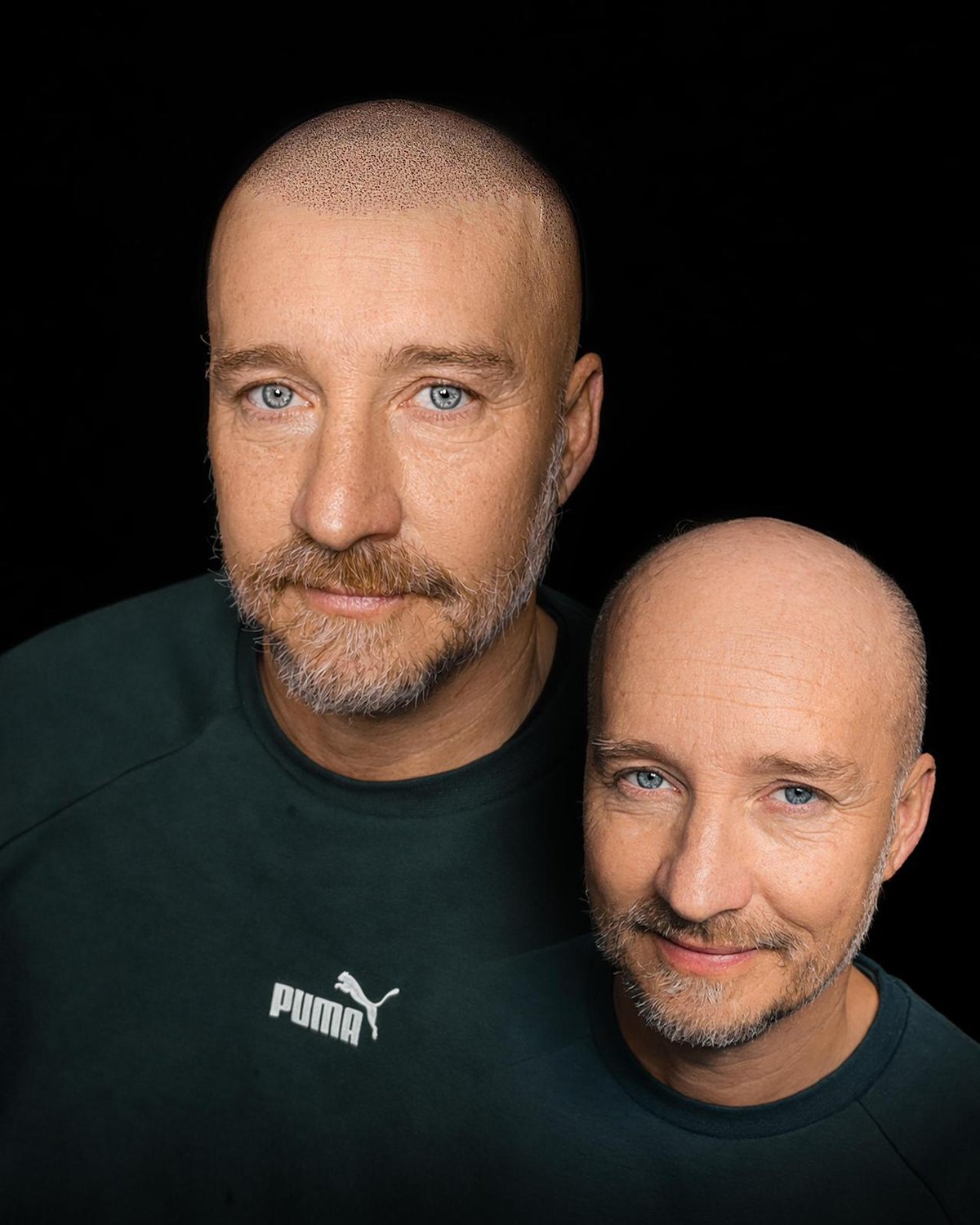 Resultado real de micropigmentación capilar — densidad y línea frontal